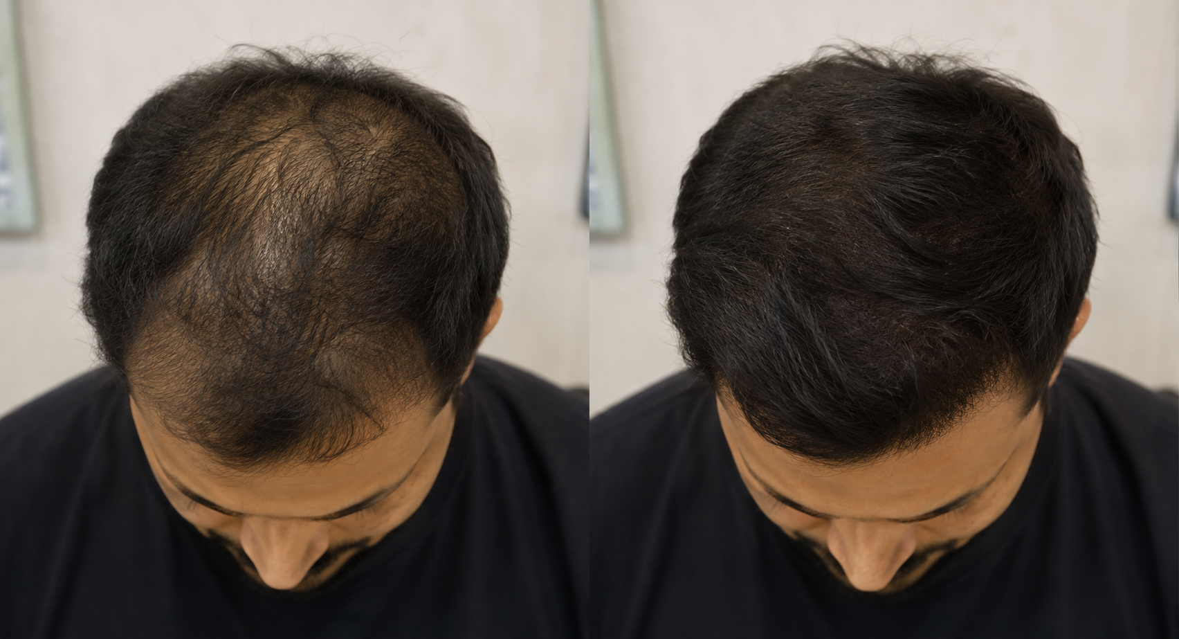 Crown Hair Restoration